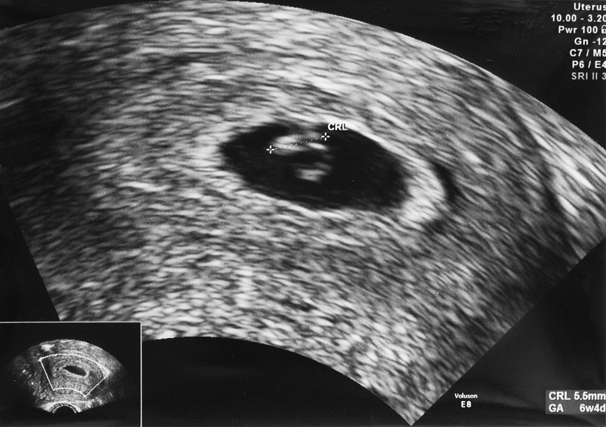 Ultrazvuk 6. tyden tehotenstvi